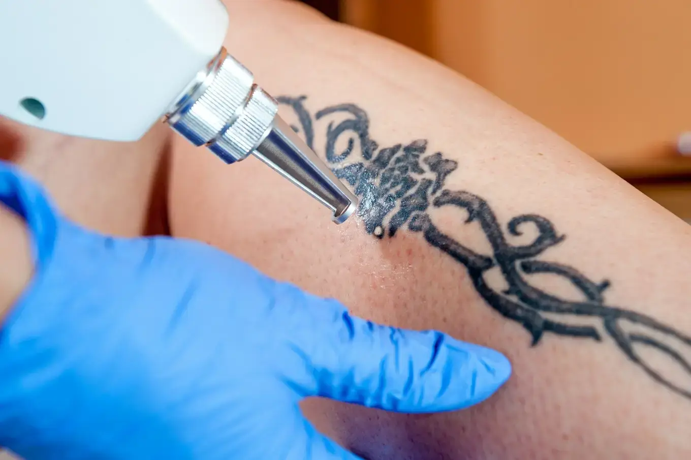 laserowe usuwanie tatuażu